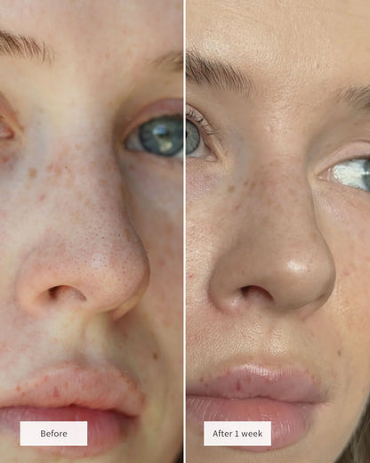 🔥50% OFF Only For Today🔥NOSE PATCHES -W18