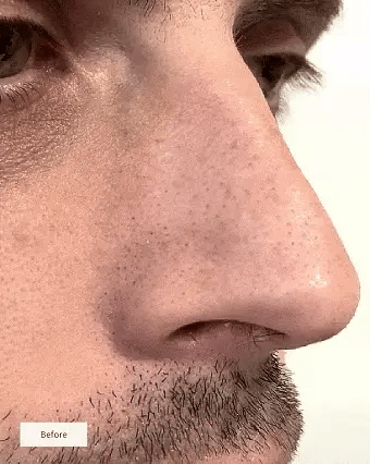 🔥50% OFF Only For Today🔥NOSE PATCHES -W18