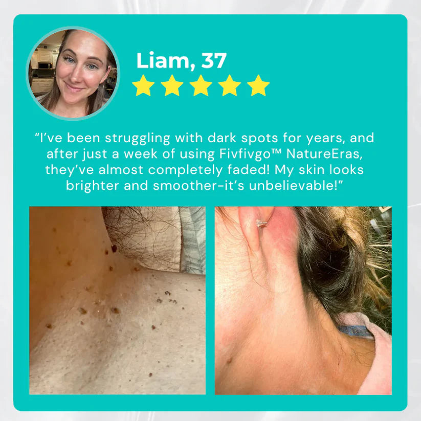 ✅ Official Store: Instant Mole & Spot Cream -W18