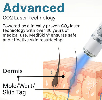SimpleSigil™Mole & Wart Removal Laser Pen-W18