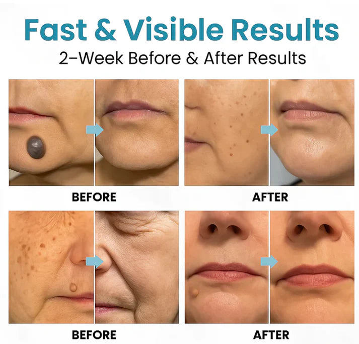 SimpleSigil™Mole & Wart Removal Laser Pen-W18